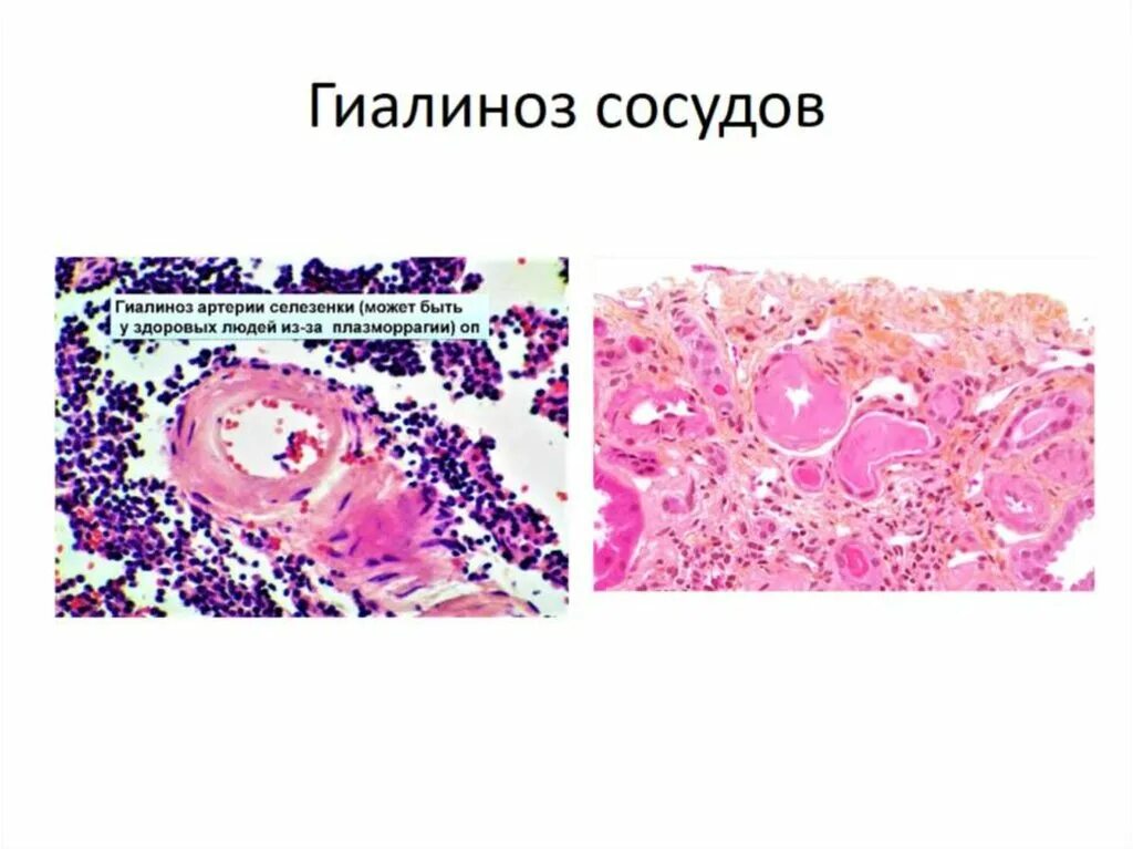 Гиалиноз сосудов селезенки макропрепарат. Гиалиноз капсулы селезенки («глазурная» селезенка). Для гиалиноза характерно. Гиалиноз сосудов гистология. Гиалиноз этиология патогенез.
