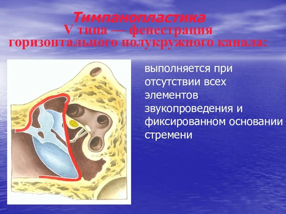 Тимпанопластика отзывы. Тимпанопластика Вульштейну. Тимпанопластика классификация.