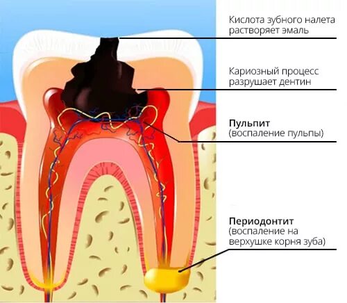 Канал гнойного. Периодонтит корня зуба. Воспаление пульпы зуба пародонтоз пульпит кариес. Пульпит 2 канального зуба.