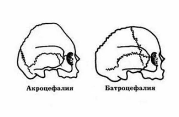 Деформация кости черепа. Пороки развития костей черепа. Деформация лицевых костей черепа. Форма черепа внутричерепное давление. Пороки развития, деформация черепа.