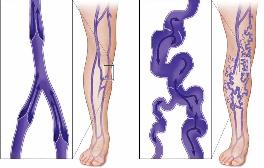 Почему нога фиолетовая. Варикозное расширение вен (ВРВ) нижних конечностей. Варикозное расширение вен нижних конечностей анатомия. Варикозное расширение вен нижних конечностей этиология и патогенез. Варикозная болезнь вен нижних конечностей стадии.