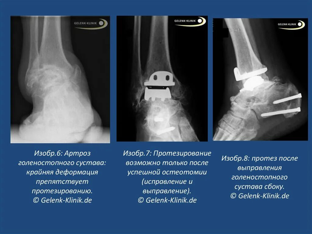 Артродез голеностопного сустава рентген описание. Артроз голеностопного сустава рентген. Анкилоз сустава голеностопного сустава. Артроз голеностопного сустава рентген стадии.