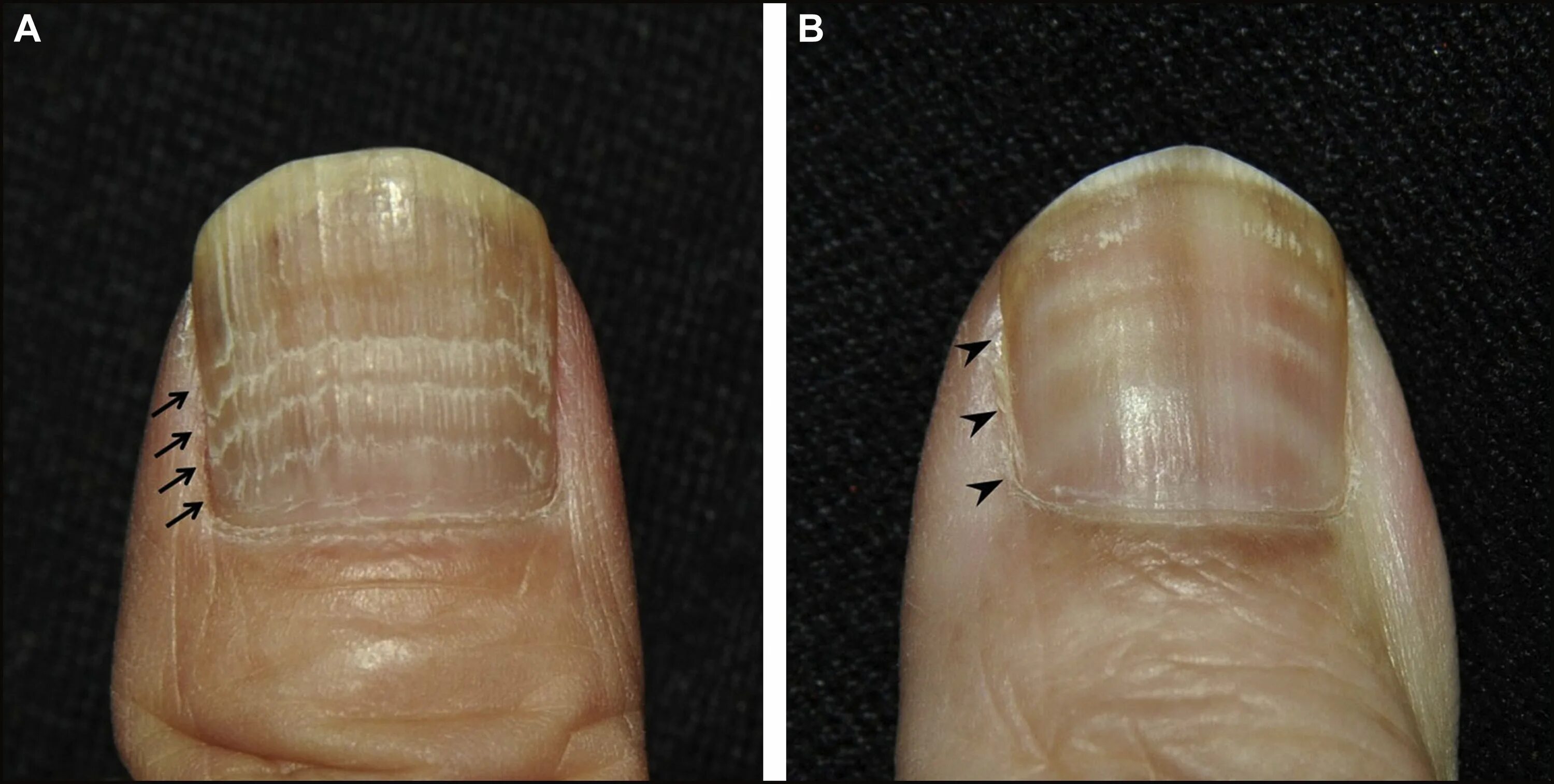 Корни ногтей находятся. Онихорексис онихомикоз. Повреждение матрикса ногтевой пластины. Поперечные борозды бо Рейля. Подногтевая меланома белая.