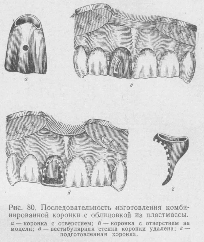 Клинико лабораторные этапы коронки по белкину. Комбинированная коронка по белкину этапы изготовления. Изготовление коронки по белкину. Клинико-лабораторные этапы изготовления комбинированной коронки. Литая металлопластмассовая коронка схема.