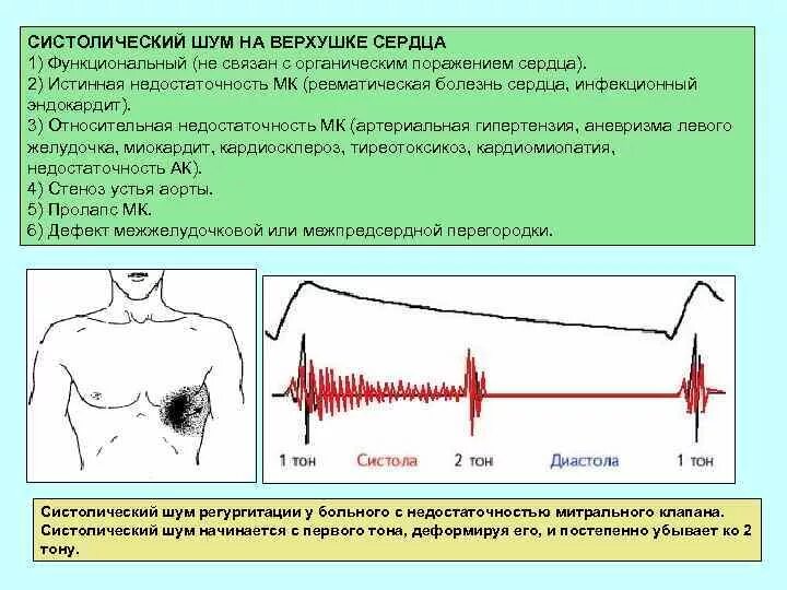 Грубый систолический шум сердца. Систолический шум выслушивается при. Систолический шум изгнания. Грубый систолический шум сердца. Грубый систолический шум при.