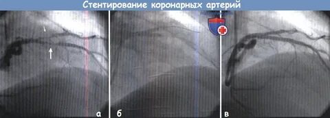 После стентирования как вести