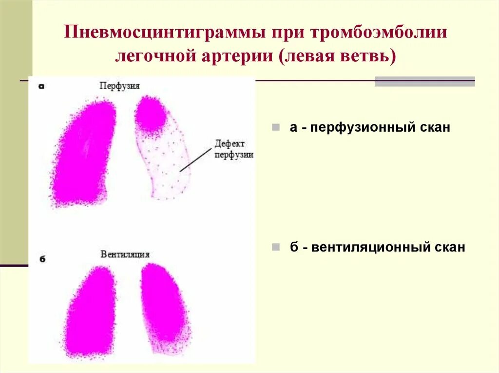 После тромбоэмболии легочной артерии. Тромбоэмболия легочной артерии. Тромбоэмболия ветвей легочной артерии. Препараты при тромбоэмболии легочной артерии. Тромбоэмболия легочной артерии статистика.