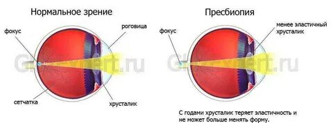 Пресбиопия сетчатки