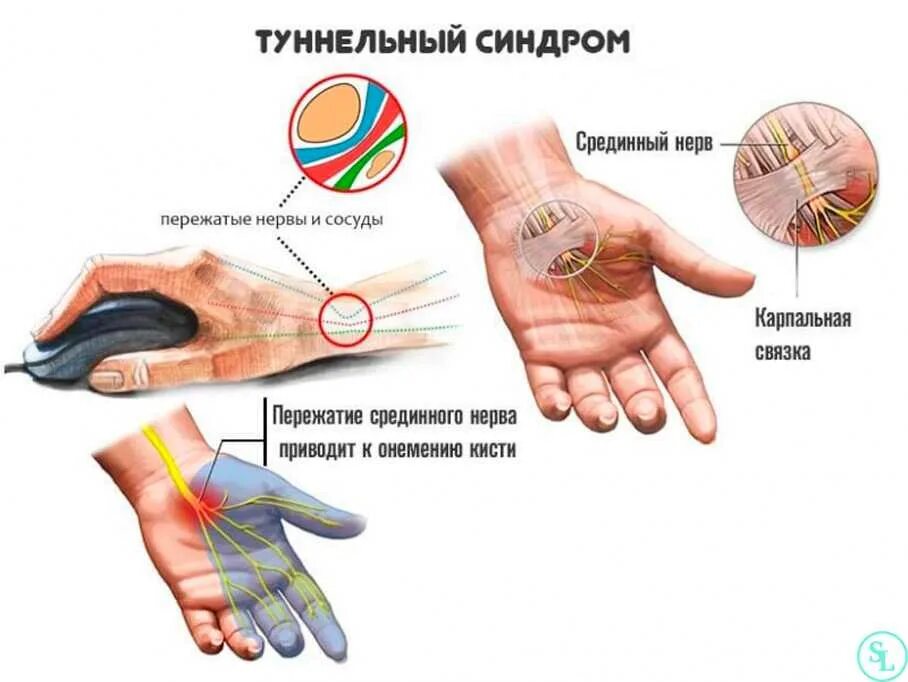 .Туннельный синдром запястья туннельный. Синдром карпального канала кисти. Симптомы туннельного синдрома запястного канала. Карпальный нерв запястья руки. Повреждение мелких артерий кистей и стоп