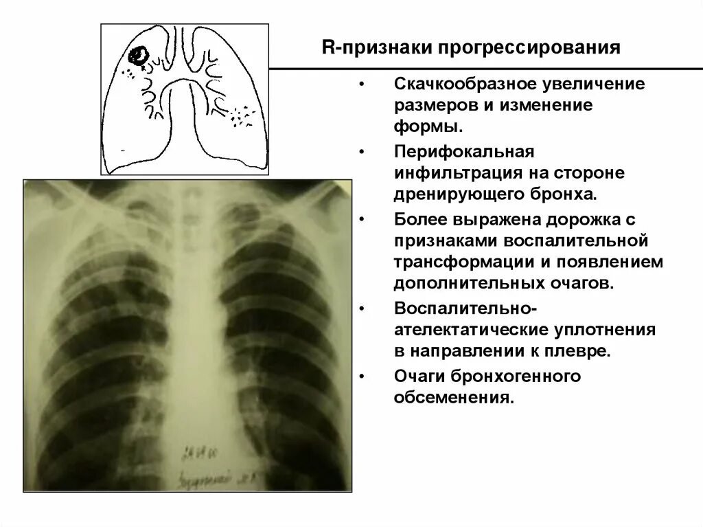 Очаговых изменений правого легкого. Очагово-инфильтративный туберкулез рентген. Очаговый туберкулез легкого рентген. Очаговый туберкулез и туберкулема рентген. Очаговый туберкулез легких рентген.