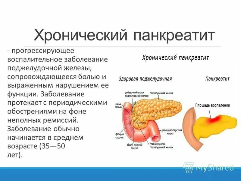 болезни пищеварительной системы человека панкреатит. панкреатит из за чего возникает. панкреатит из за чего возникает. острый панкреатит поджелудочной железы. панкреатит из за чего возникает.