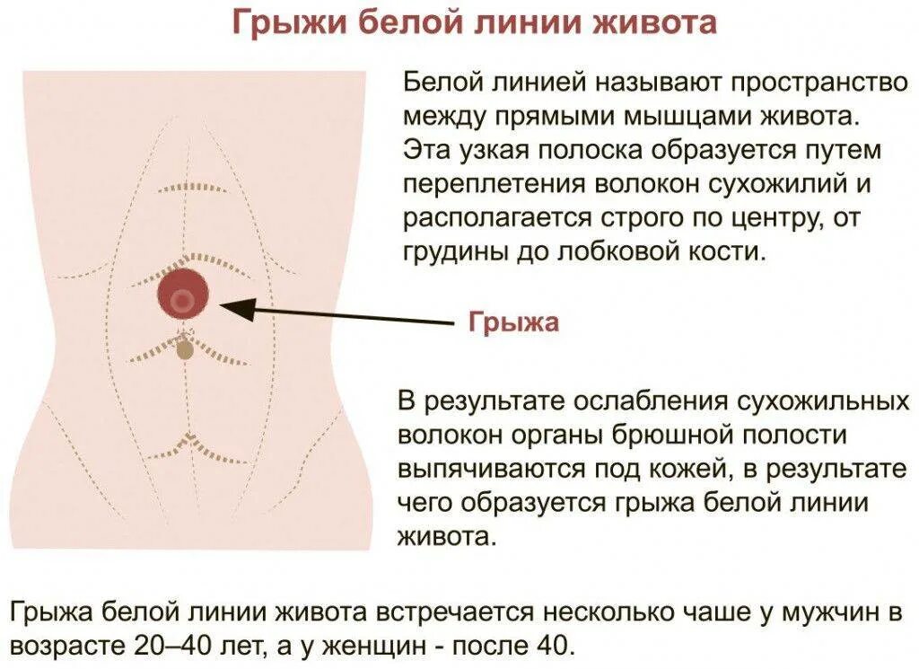 Боль в околопупочной области живота. Грыжа белой линии живота анатомические предпосылки. Подпупочная грыжа белой линии живота. Гоыжа белой линиижиаота. Грыжа бедойлинии живота.