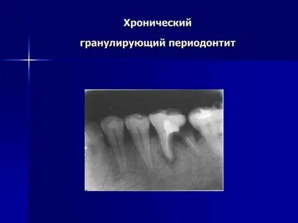 Лечение хронического фиброзного периодонтита