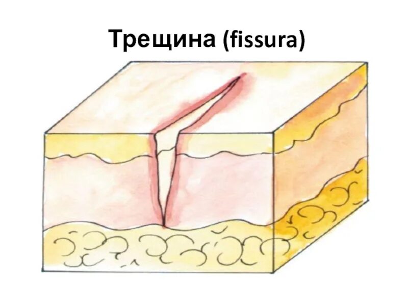 Заживление трещины в заднем. Вторичные элементы сыпи трещина. Эрозия вторичный элемент сыпи. Эрозия Дерматовенерология. Эрозия вторичный морфологический элемент.