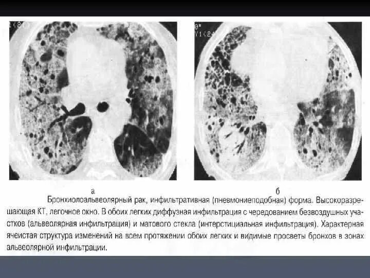 Бронхоальвеолярная карцинома на кт. Бронхоальвеолярная карцинома легких кт. Пневмониеподобная форма бар кт. Диффузный рак легких