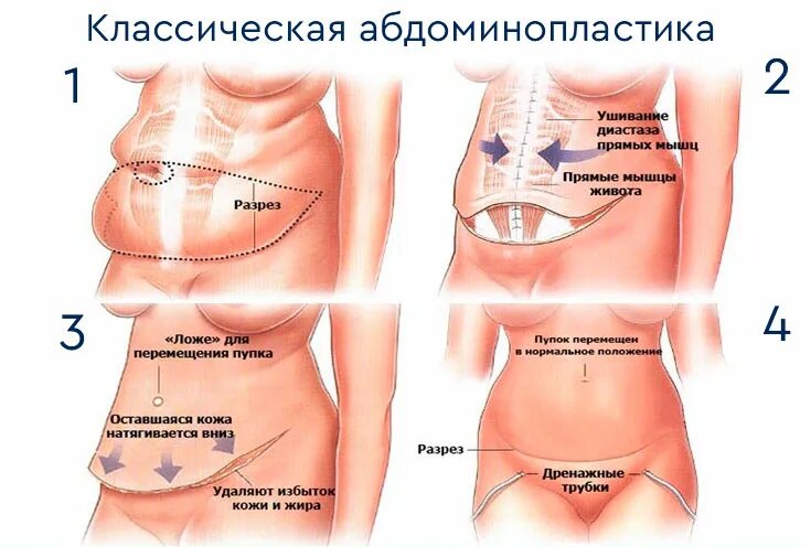 Стоит живот что делать. Продольная абдоминопластика. абдоминопластика живота схема. пластика живота абдоминопластика.