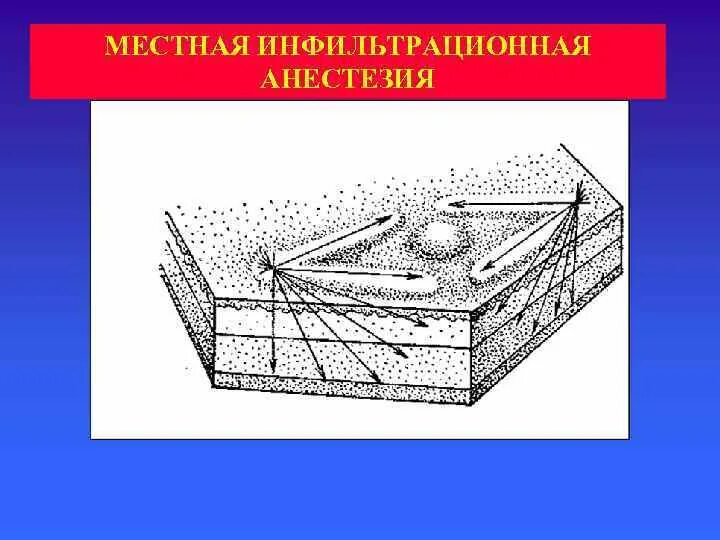 Проведение инфильтрационной анестезии