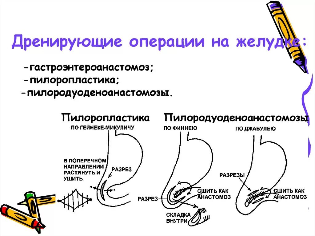 Операции дренирующего типа на желудке. Операции дренирования желудка. Укажите дренирующие желудок операции. Дренирующие операции при лечении язвенной болезни 12-перстной кишки. Укажите внутренние операции