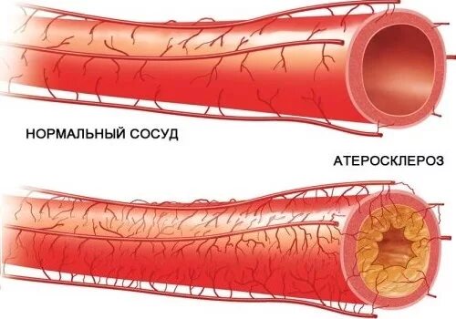 Повреждение сосуда атеросклероз. Атеросклероз (закупорка кровеносных сосудов).