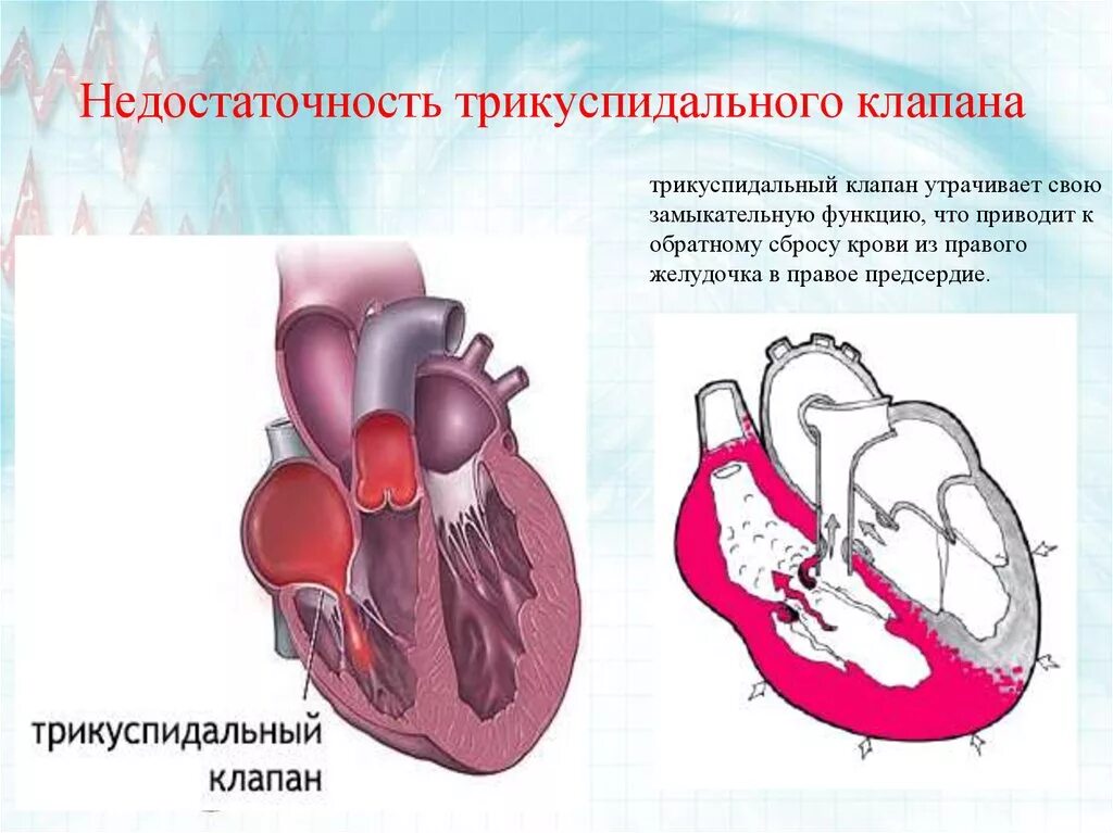 Недостаточность предсердия. Недостаточность трехстворчатого клапана гемодинамика. Гемодинамика при недостаточности трикуспидального клапана. Недостаточность правого предсердно-желудочкового клапана. Недостаточность трехстворчатого клапана сердца.