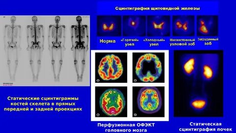 Сцинтиграфия