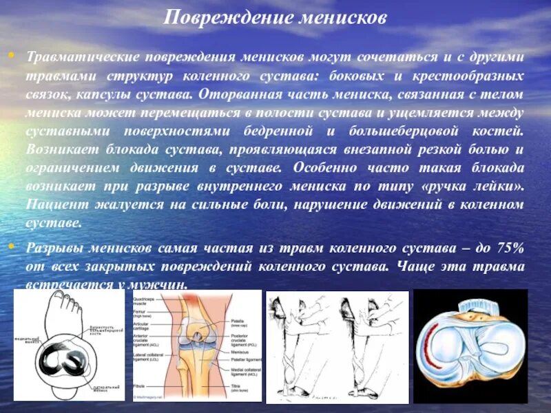 Болит ли мениск. Разрыв мениска коленного сустава. Повреждение менисков коленного сустава. Симптомы повреждения менисков. Симптомы повреждения менисков коленного сустава.