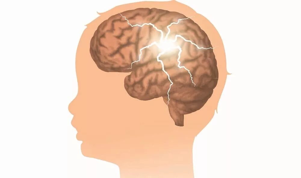 Мозг ребенка видео. Мозг ребенка. Эпилептический мозг.