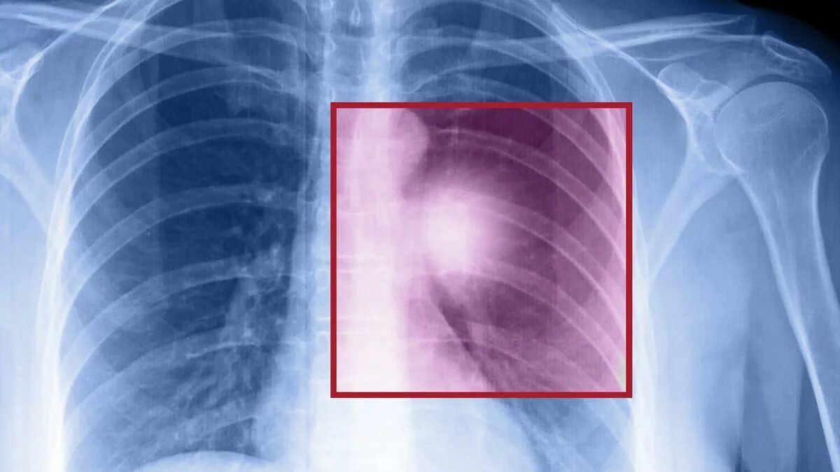 Трещина в ребре что делать. Рентген грудной клетки перелом ребер. Перелом 10 ребра слева снимок.