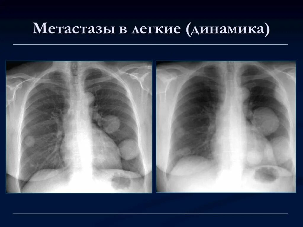 Lungenmetastasen beim Osteosarkom - YouTube
