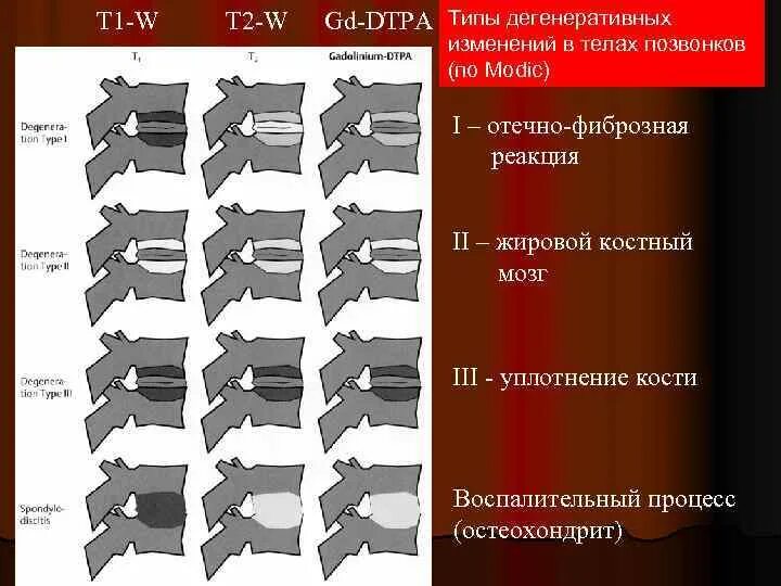 Жировая дегенерация костного мозга