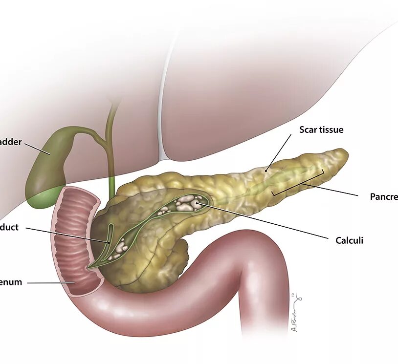 В поджелудочной бывают камни. Панкреатит поджелудочной железы. Панкреатит воспаление поджелудочной железы. Воспаление поджелудка.