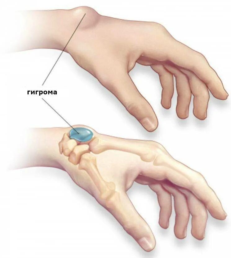 Гигрома лучезапястного. Ганглий лучезапястного сустава. Гигрома запястья (лучезапястного сустава). Причины гигрома лучезапястного сустава. Боль в суставе запястья