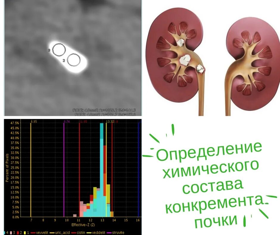 Мелкий конкремент правой почки что это. Конкремент правой почки кт. Плотность конкрементов почек на кт. Локализация конкрементов почек.