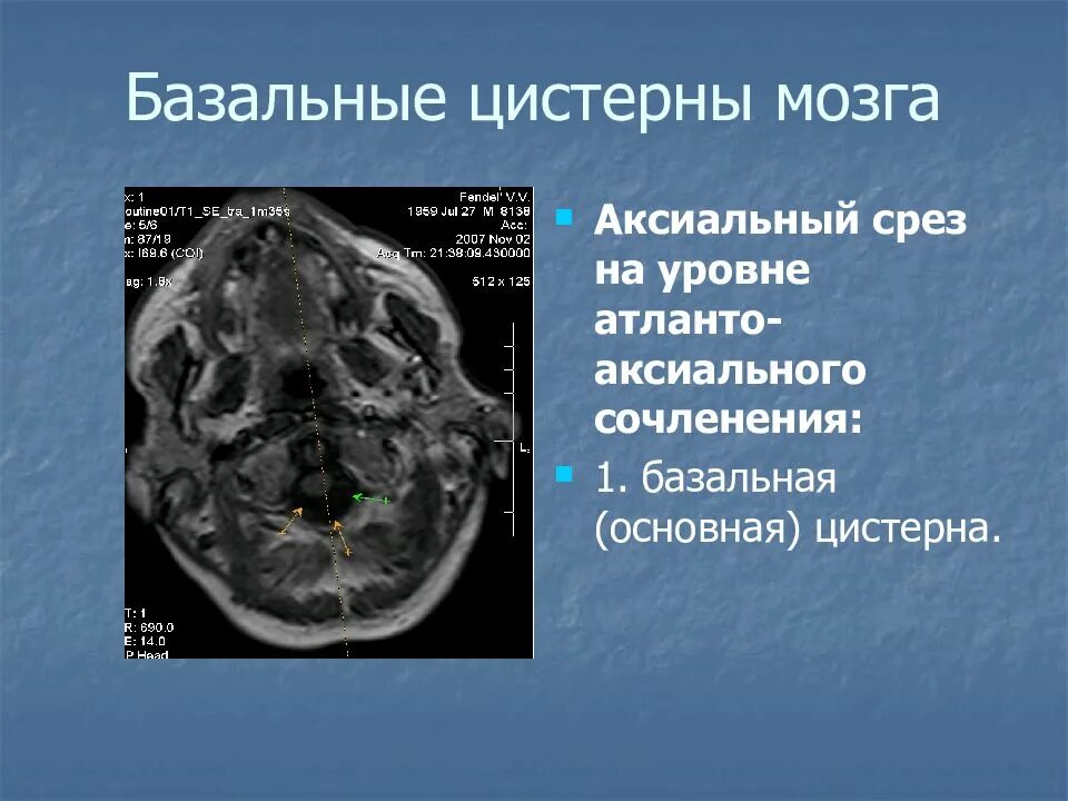 Большая цистерна больше нормы. Базальные цистерны головного мозга кт анатомия. Базальные цистерны головного мозга расширены что это. Базальные цистерны головного мозга на мрт. Базальные цистерны головного мозга кт.