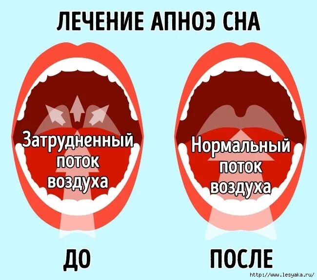 Апноэ сна симптомы у взрослых. Синдром апноэ во сне. апноэ во сне у взрослых. ночное апноэ.