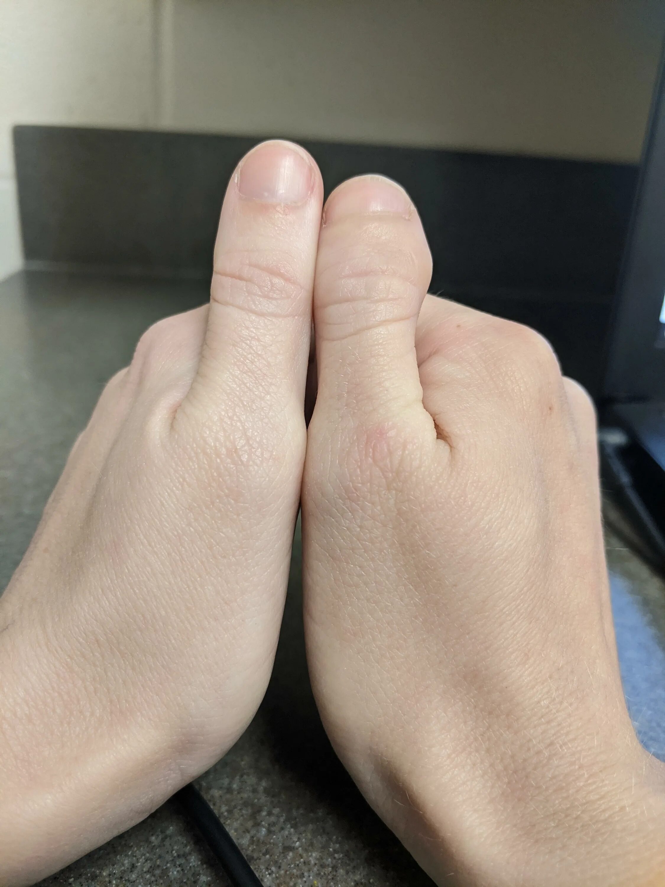 Маленький большой палец. Большие пальцы на руках широкие.
