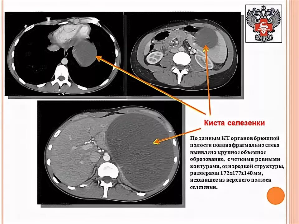 Киста селезенки лечение. Кистозные образования селезенки на кт. Эпидермоидная киста селезенки мрт. Еиств селезенки на кт.