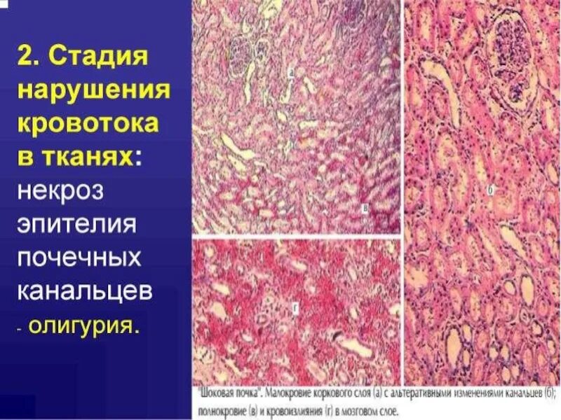 Стадии нарушения кровообращения. Нарушения кровообращения патанатомия. Анатомия и патанатомия человека.