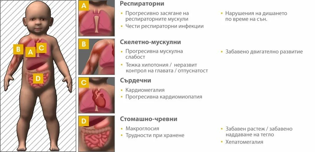 Болезнь помпе у детей. Болезнь помпе клинические проявления. болезнь помпе симптомы у детей. болезнь помпе инфантильная форма.