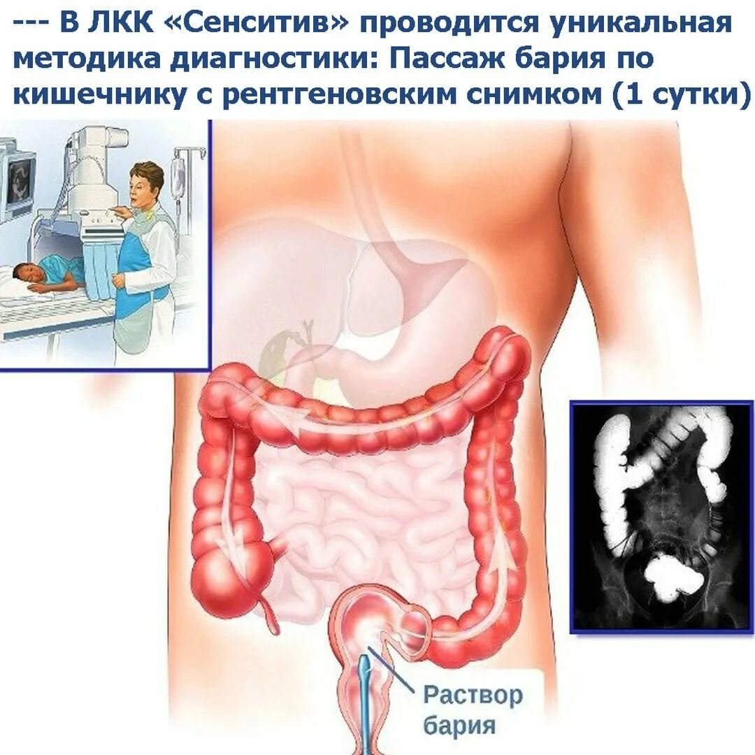 Рентгенологическое исследование толстого кишечника (ирригоскопия). Рентгенологический метод исследования толстого кишечника. Ирригоскопия и ирригография. Ирригоскопия толстого кишечника. Рентгенологическое исследование толстого кишечника (ирригоскопия).