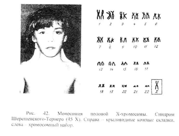 Вторая х хромосома. Набор хромосом при синдроме Тернера Шерешевского. Синдром Тернера хромосомный набор. Моносомия по х-хромосоме синдром Шерешевского -Тернера кариотип 45 Хо. Синдром Шерешевского Тернера моносомия.