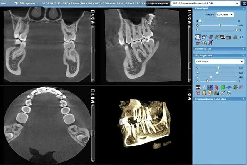 Где сделать кт зуба. Компьютерная томография 2-х челюстей.