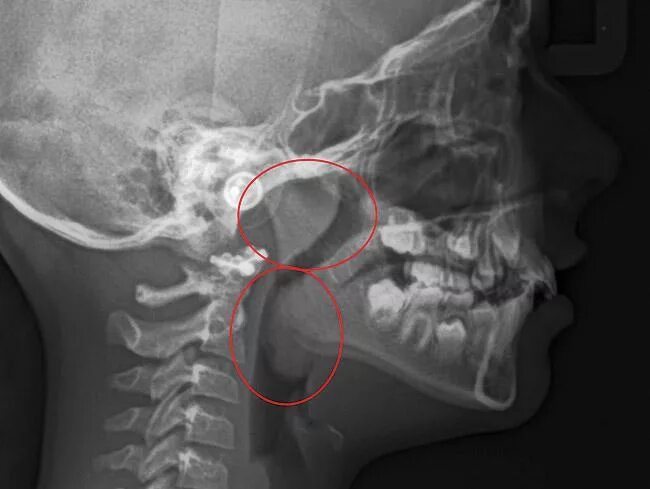 рентген носоглотки аденоиды. аденоиды 2 степени рентген. рентген носоглотки аденоиды. аденоиды рентген степени. рентген аденоиды радиография.