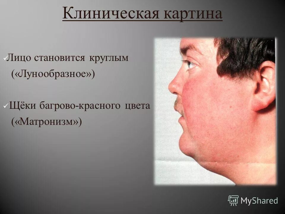 Розацеа телеангиэктазии. Человек с краснойткожей. Эритемато телеангиоэктазическая розацеа. Лицо стало багровым. Эритематозно-телеангиэктатический рощацеа.