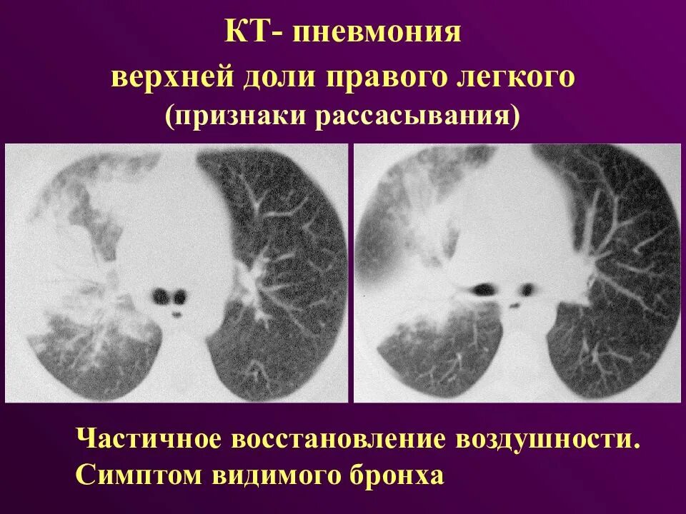 Как выглядит пневмония на кт. Пневмония на кт. бактериальная пневмония на кт. пневмония верхней доли легкого.