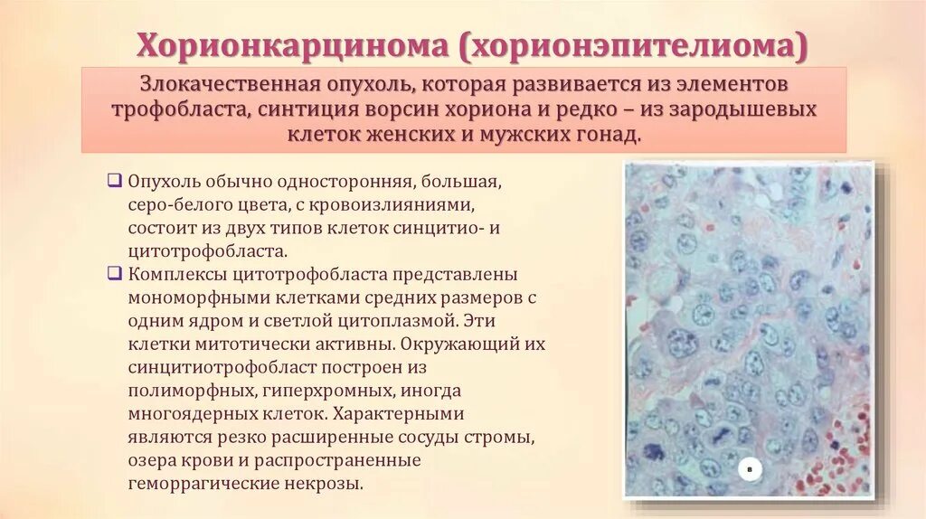 Папиллярная уротелиальная карцинома гистология. Дентинома это патанатомия. Опухоль развивающаяся из эпителия. Холангиоцеллюлярная опухоль печени. Новообразование лимфоидной кроветворной ткани.