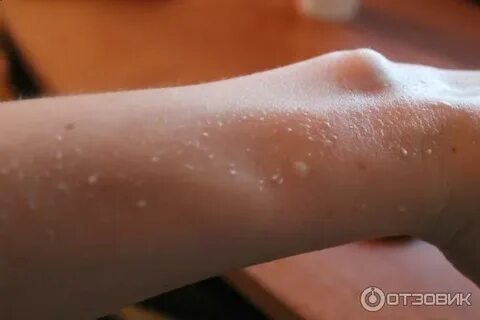 Белая кожа на солнце