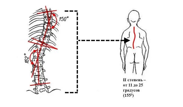 Искривление позвоночника градусы. Искривление позвоночника 2 степени. Сколиоз 2 степени градусы. Сколиоз 2 степени 17 градусов. Дугообразный сколиоз 2 степени.