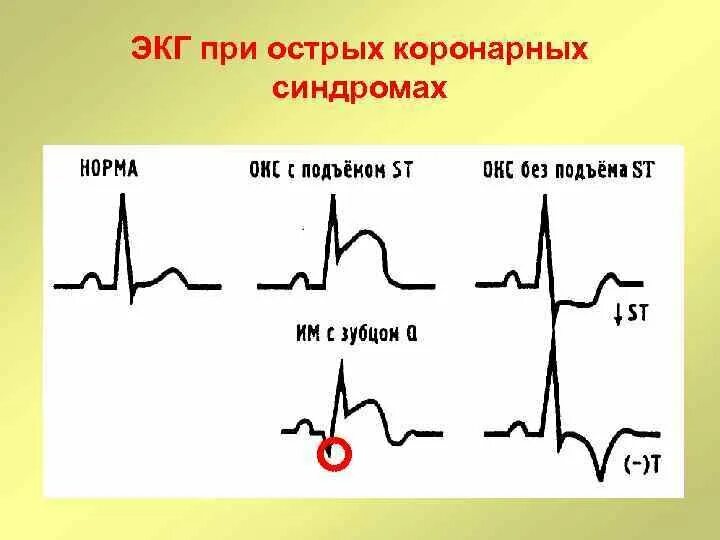 Экг подъем. Окс c подъемом сегмента St ЭКГ. ЭКГ Окс без подъема сегмента St. ЭКГ острый инфаркт миокарда с подъемом сегмента St. Инфаркт миокарда без подъема сегмента St ЭКГ.