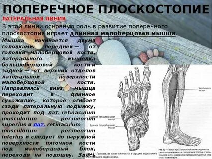 Плоская стопа код мкб